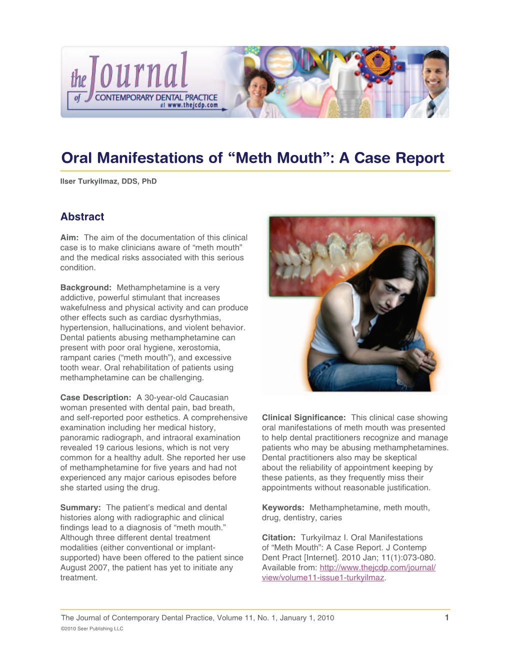 Oral Manifestations of “Meth Mouth”: a Case Report