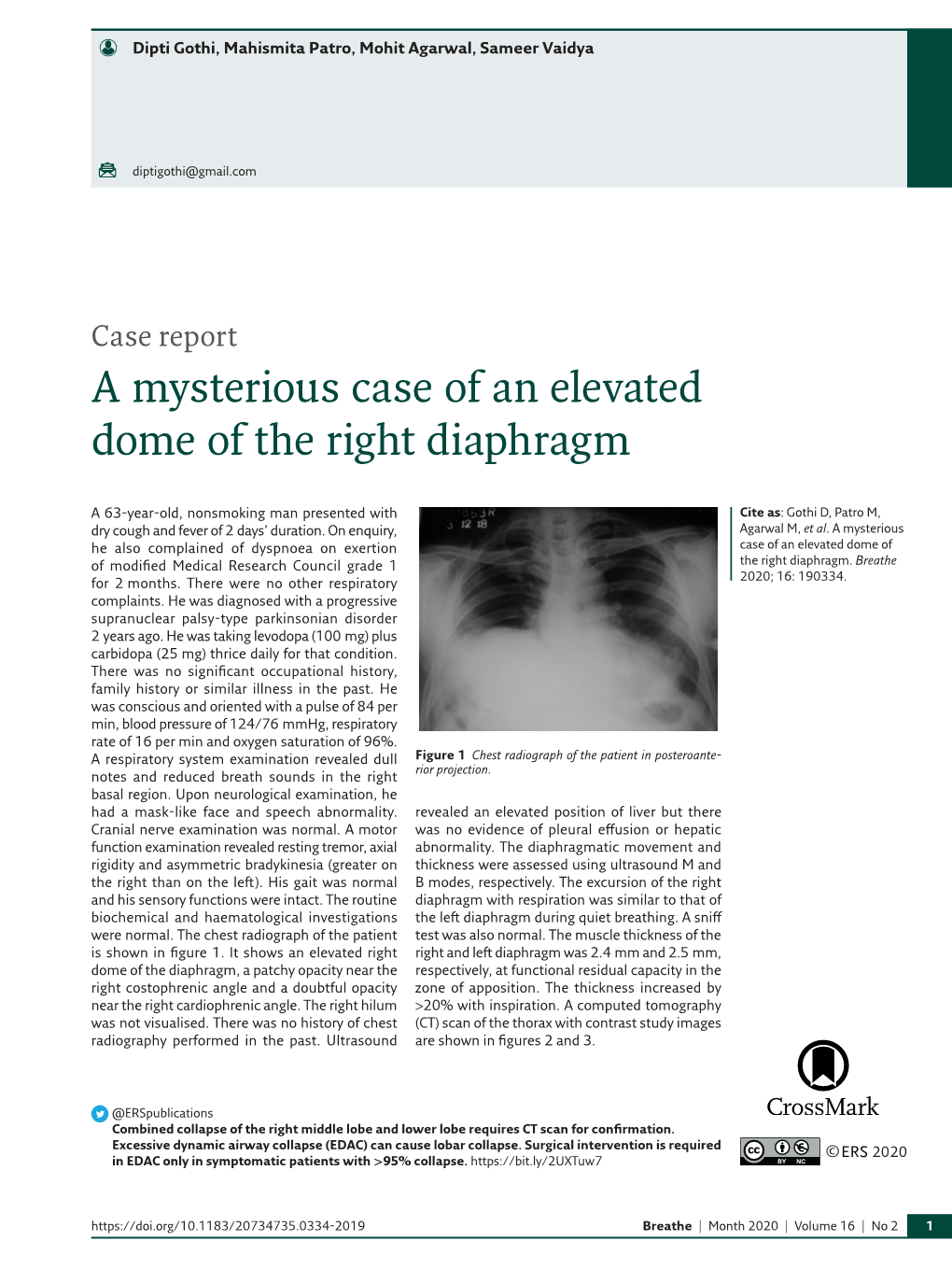 A Mysterious Case of an Elevated Dome of the Right Diaphragm