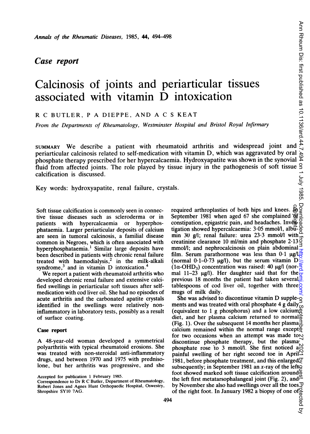 Calcinosis of Joints and Periarticular Tissues Associated with Vitamin D Intoxication