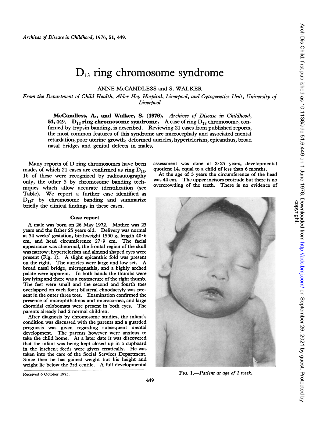 D13 Ring Chromosome Syndrome ANNE Mccandless and S