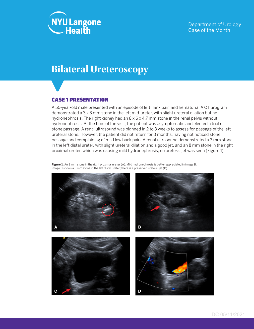 Bilateral Ureteroscopy