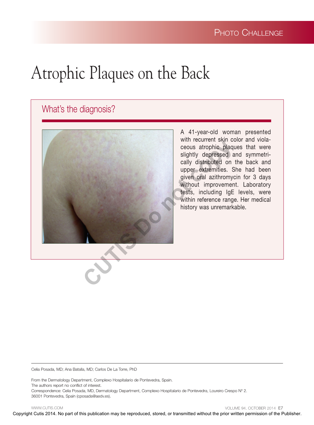 Atrophic Plaques on the Back