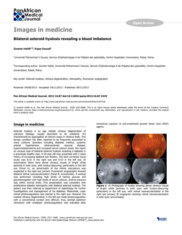 Images in Medicine Bilateral Asteroid Hyalosis Revealing a Blood Imbalance