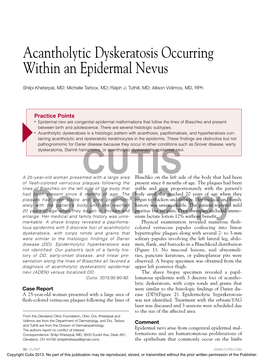 Acantholytic Dyskeratosis Occurring Within an Epidermal Nevus