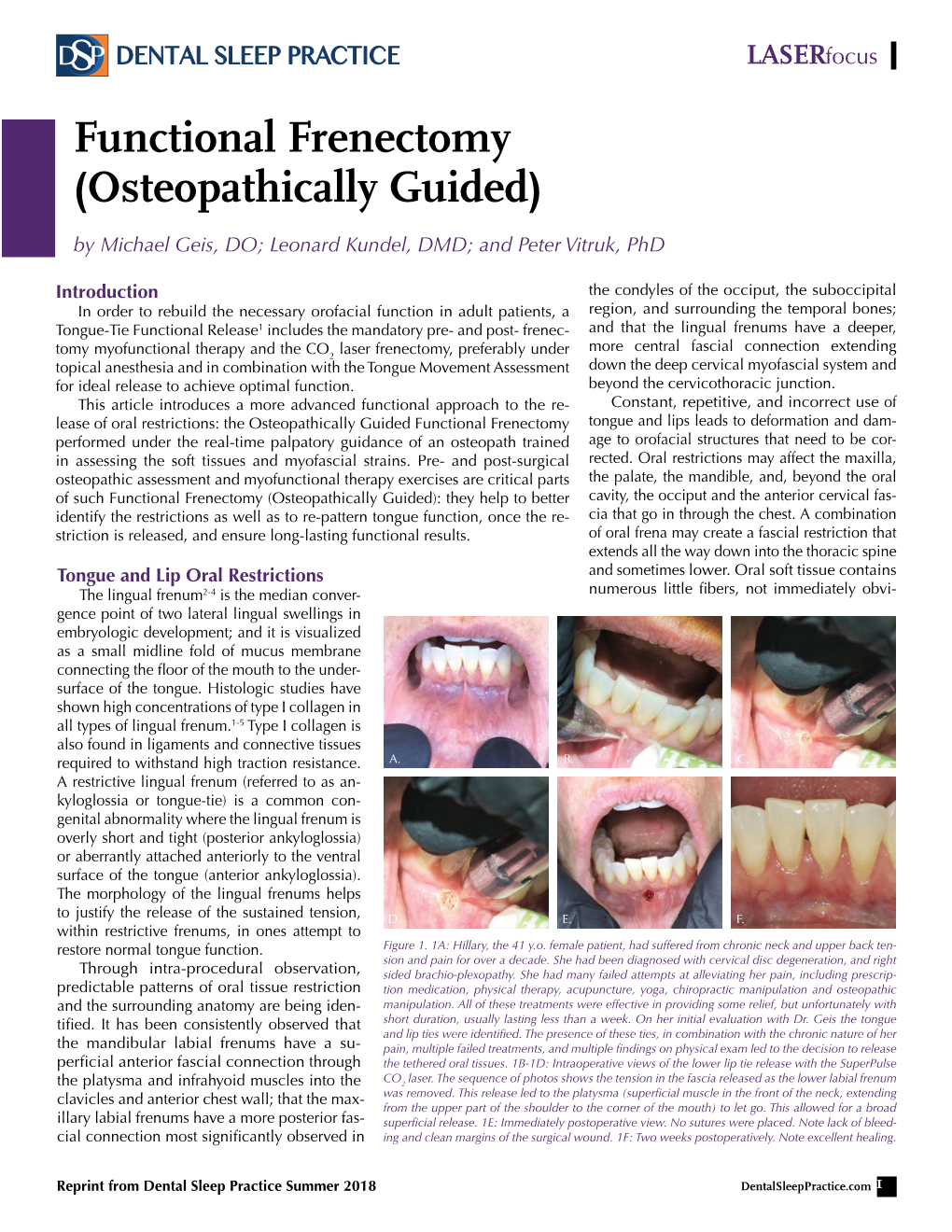 Functional Frenectomy (Osteopathically Guided)