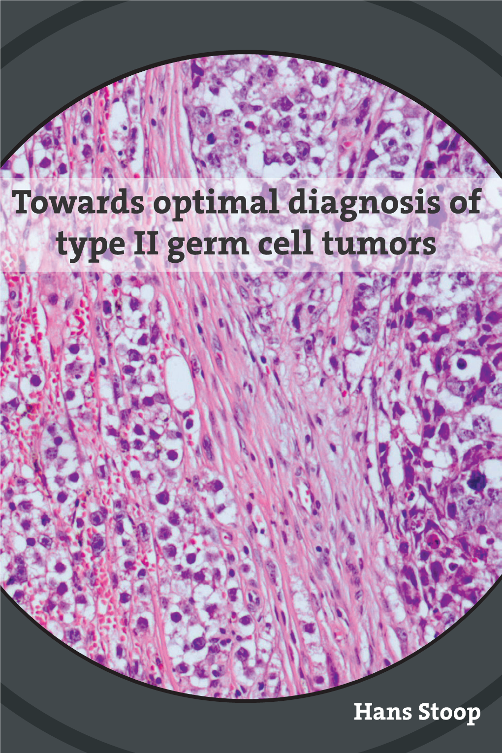 Towards Optimal Diagnosis of Type II Germ Cell Tumors
