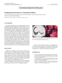 Esophageal Perforation by a Sengstaken Balloon