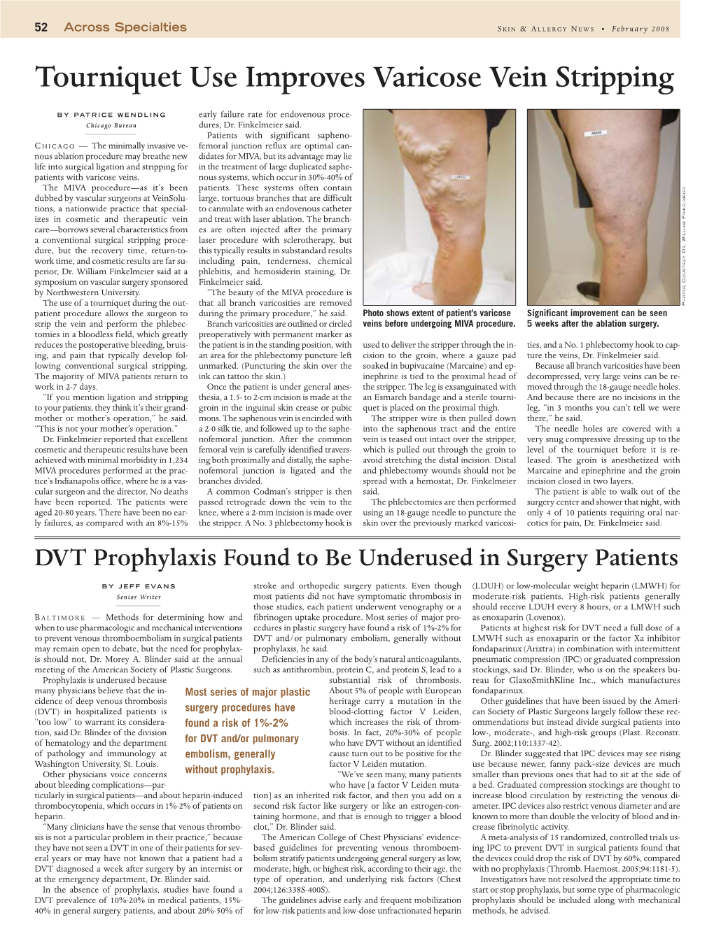 Tourniquet Use Improves Varicose Vein Stripping