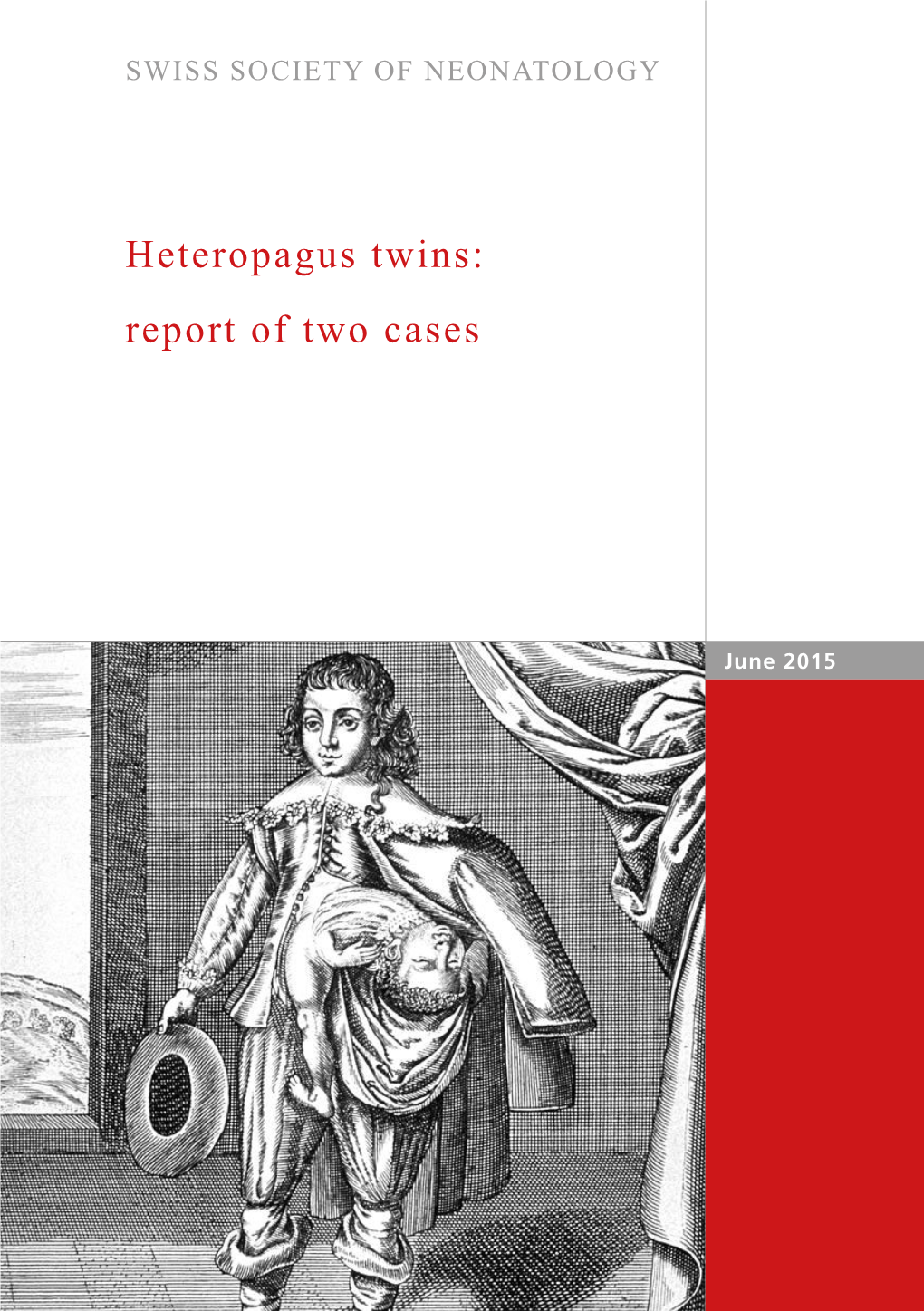 Heteropagus Twins: Report of Two Cases