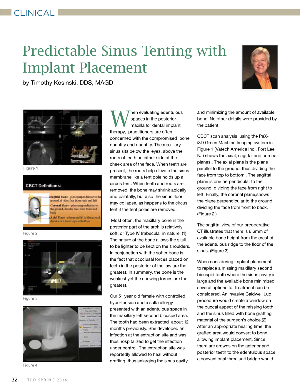 Predictable Sinus Tenting with Implant Placement by Timothy Kosinski, DDS, MAGD