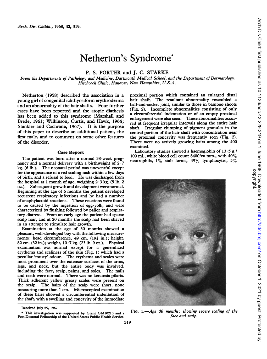 Netherton's Syndrome* P