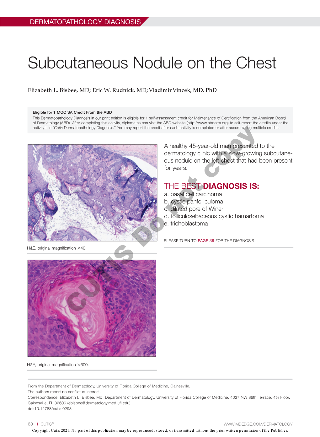 Subcutaneous Nodule on the Chest