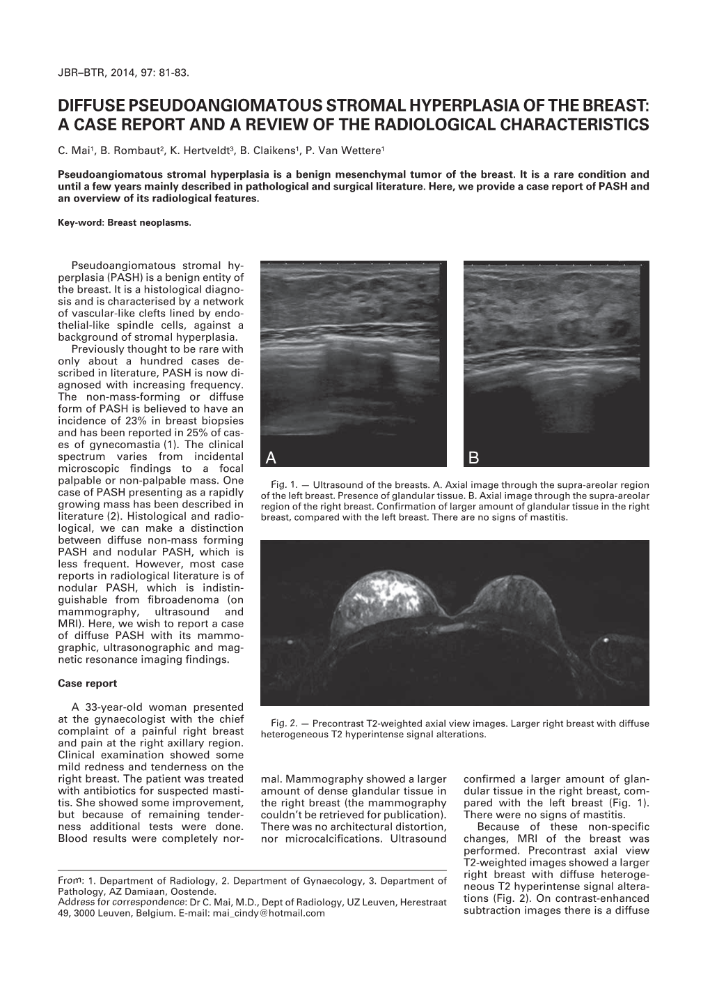 Diffuse Pseudoangiomatous Stromal Hyperplasia of the Breast: a Case Report and a Review of the Radiological Characteristics