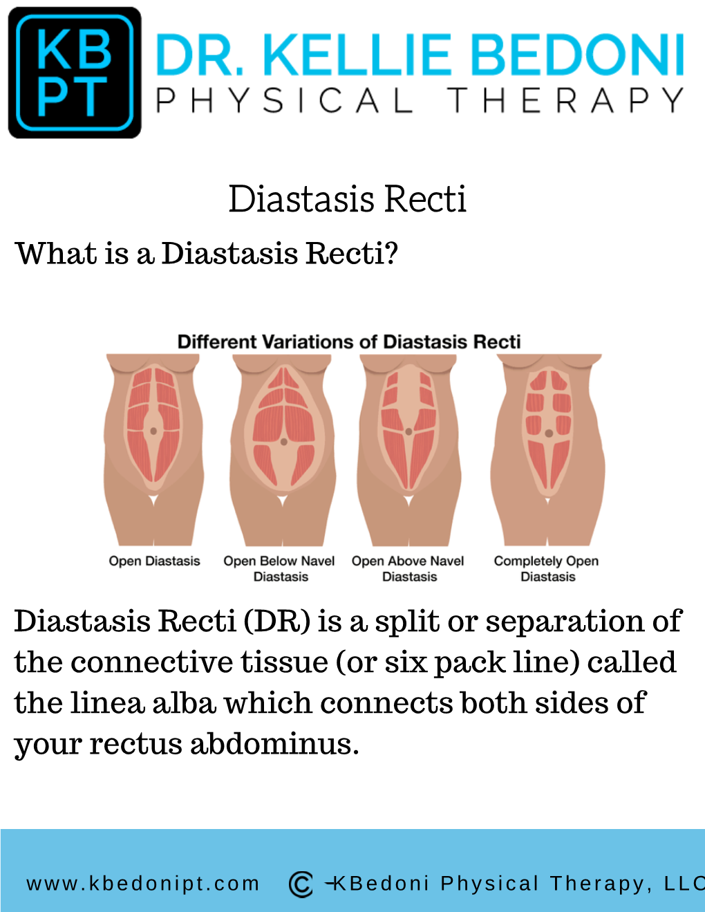Diastasis Recti What Is a Diastasis Recti?