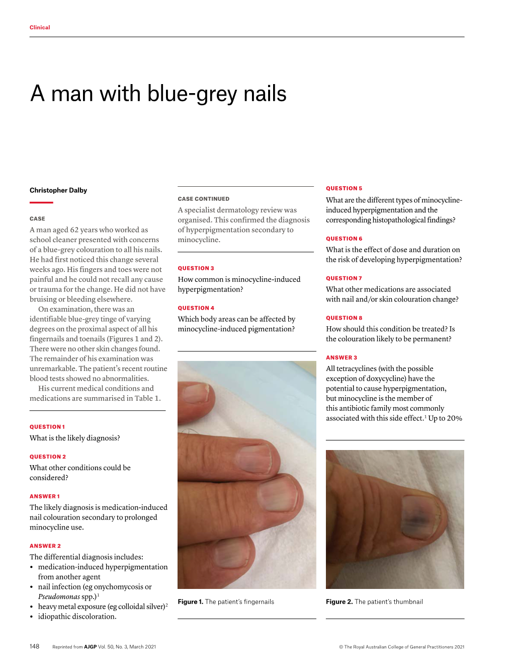 A Man with Blue-Grey Nails