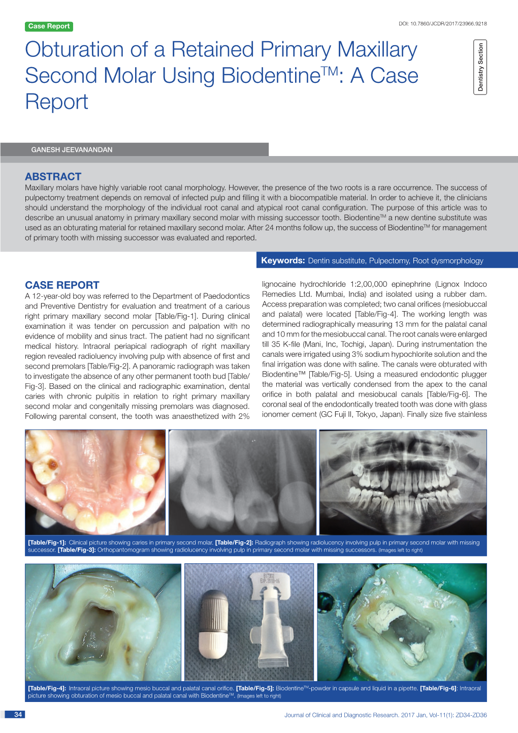 Obturation of a Retained Primary Maxillary Second Molar Using Biodentinetm: a Case Dentistry Section Report