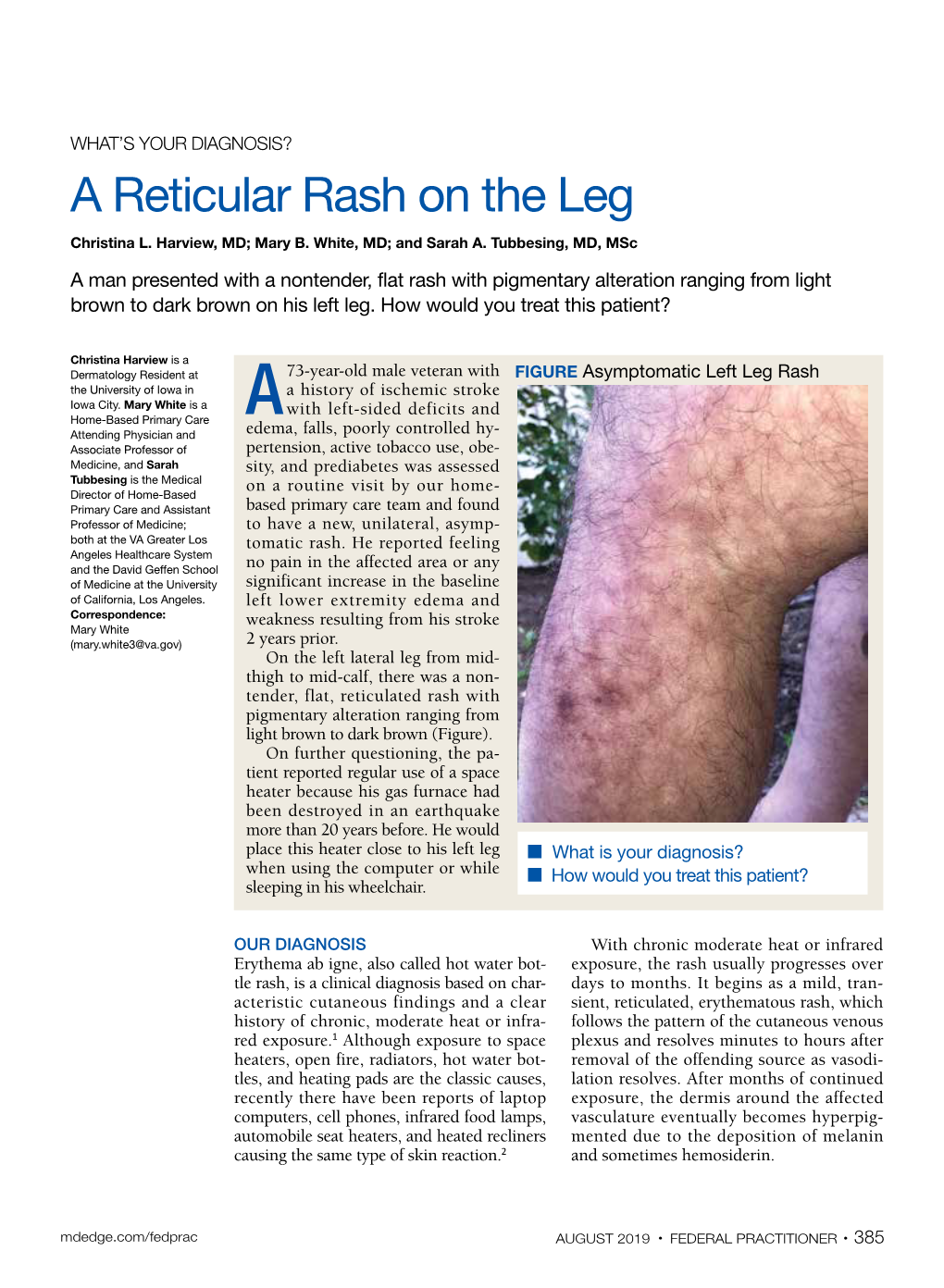A Reticular Rash on the Leg Christina L