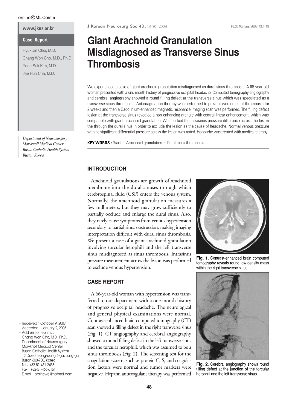 Giant Arachnoid Granulation Misdiagnosed As Transverse Sinus