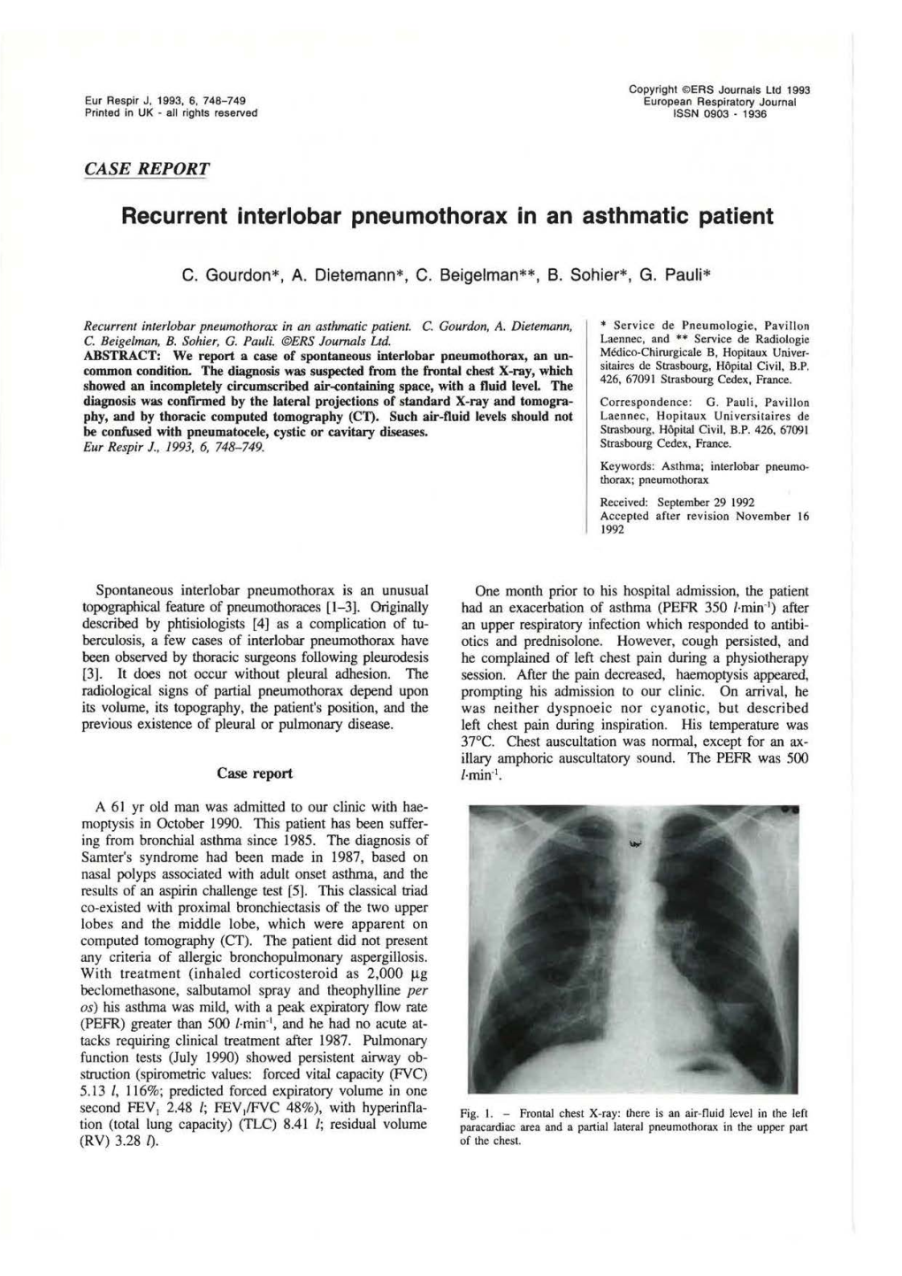 Recurrent Interlobar Pneumothorax in an Asthmatic Patient