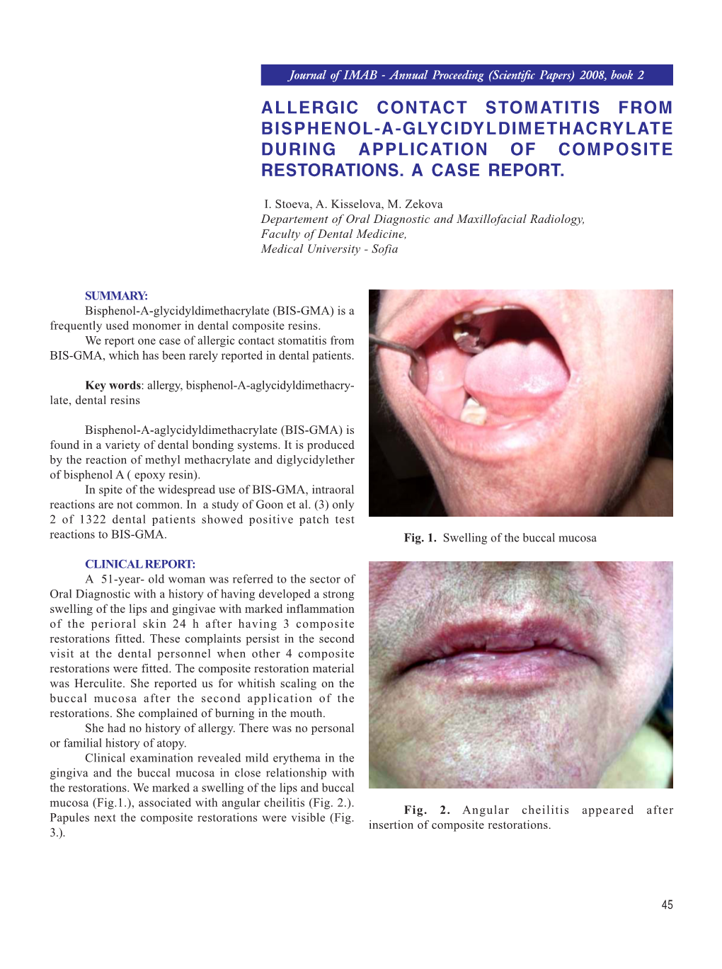 Allergic Contact Stomatitis from Bisphenol-A-Glycidyldimethacrylate During Application of Composite Restorations
