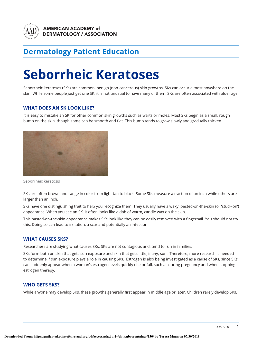 Seborrheic Keratoses Seborrheic Keratoses (Sks) Are Common, Benign (Non-Cancerous) Skin Growths