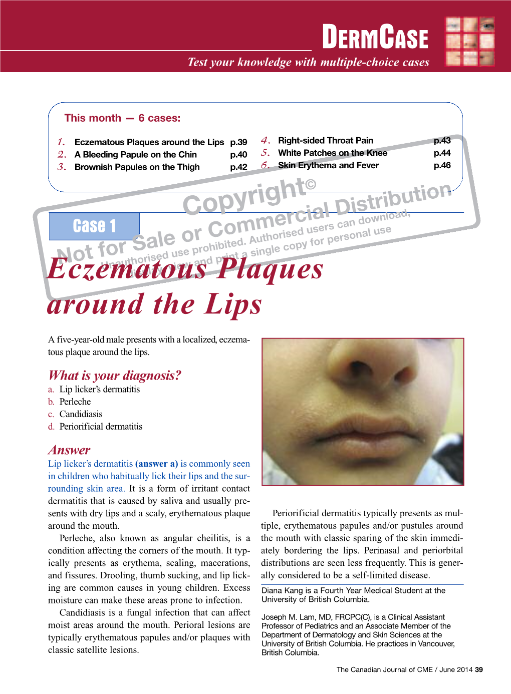 Eczematous Plaques Around the Lips P.39 4