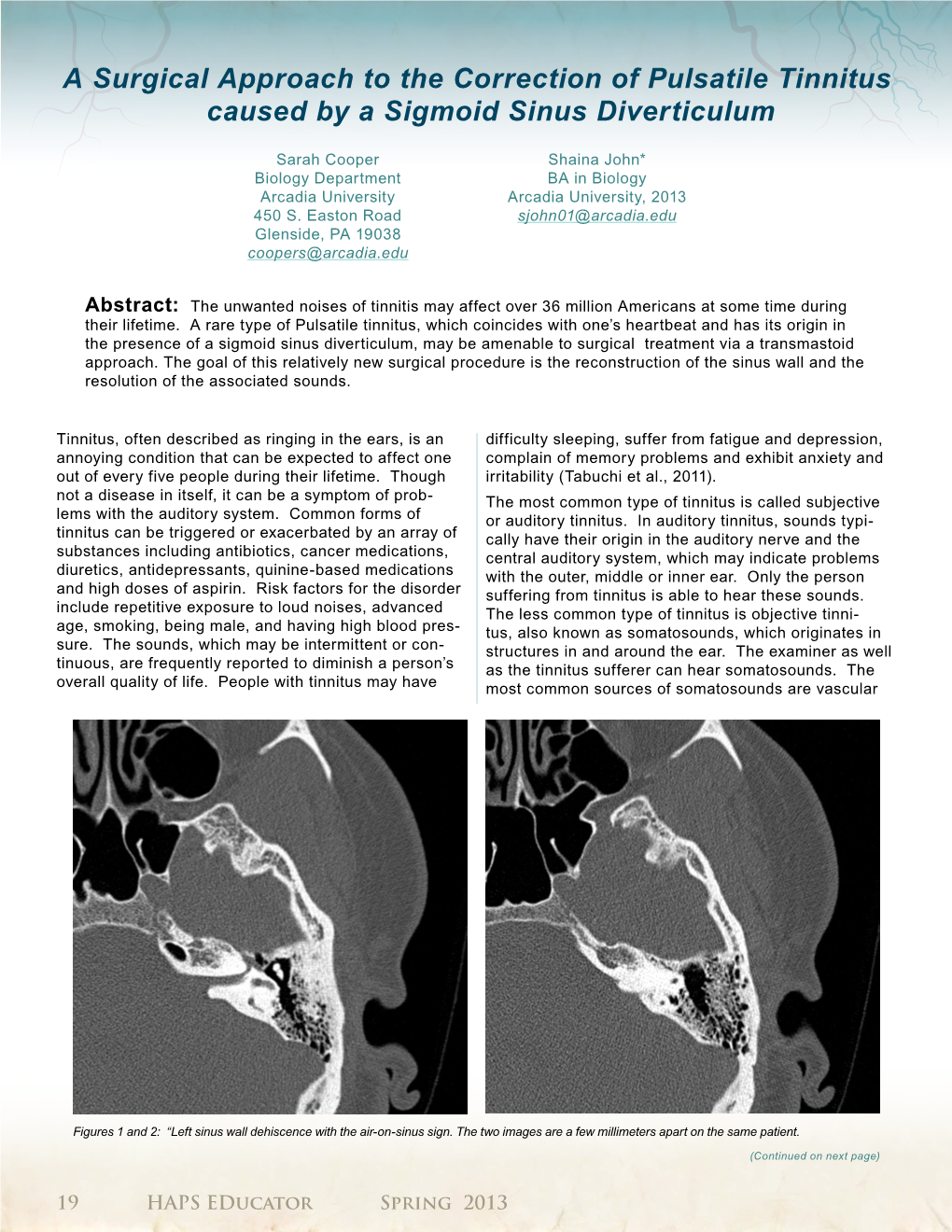 A Surgical Approach to the Correction of Pulsatile Tinnitus Caused by a Sigmoid Sinus Diverticulum