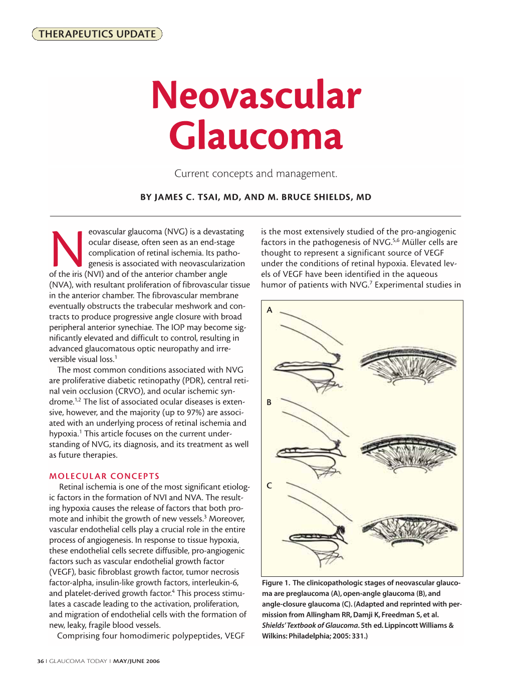 Neovascular Glaucoma Current Concepts and Management