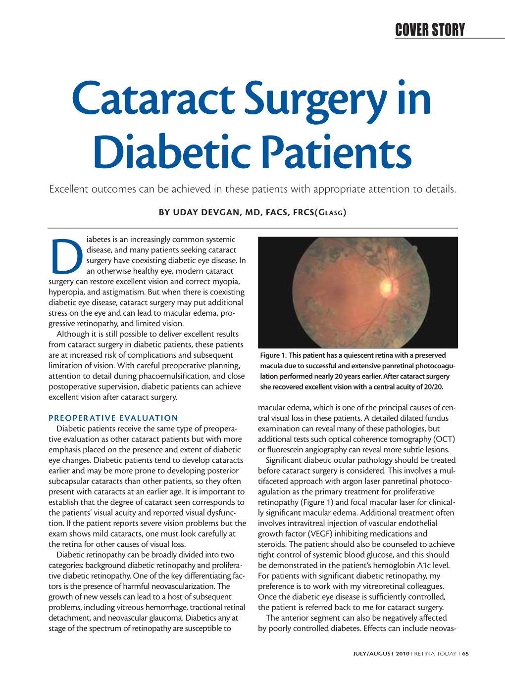 Cataract Surgery in Diabetic Patients Excellent Outcomes Can Be Achieved in These Patients with Appropriate Attention to Details