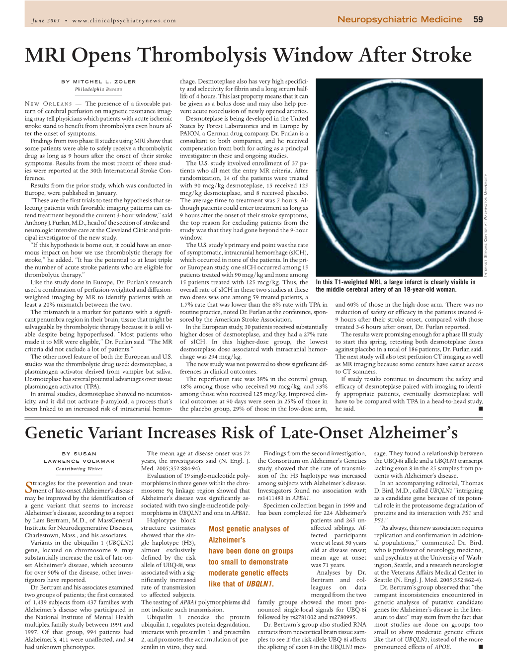 MRI Opens Thrombolysis Window After Stroke