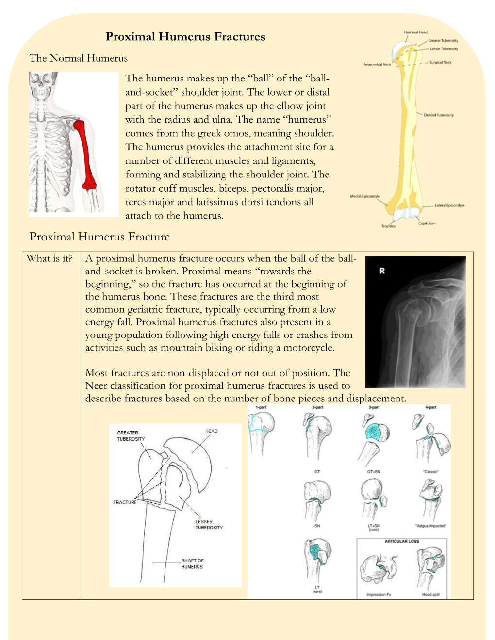 Proximal Humerus Fractures the Normal Humerus the Humerus Makes up the “Ball” of the “Ball- And-Socket” Shoulder Joint