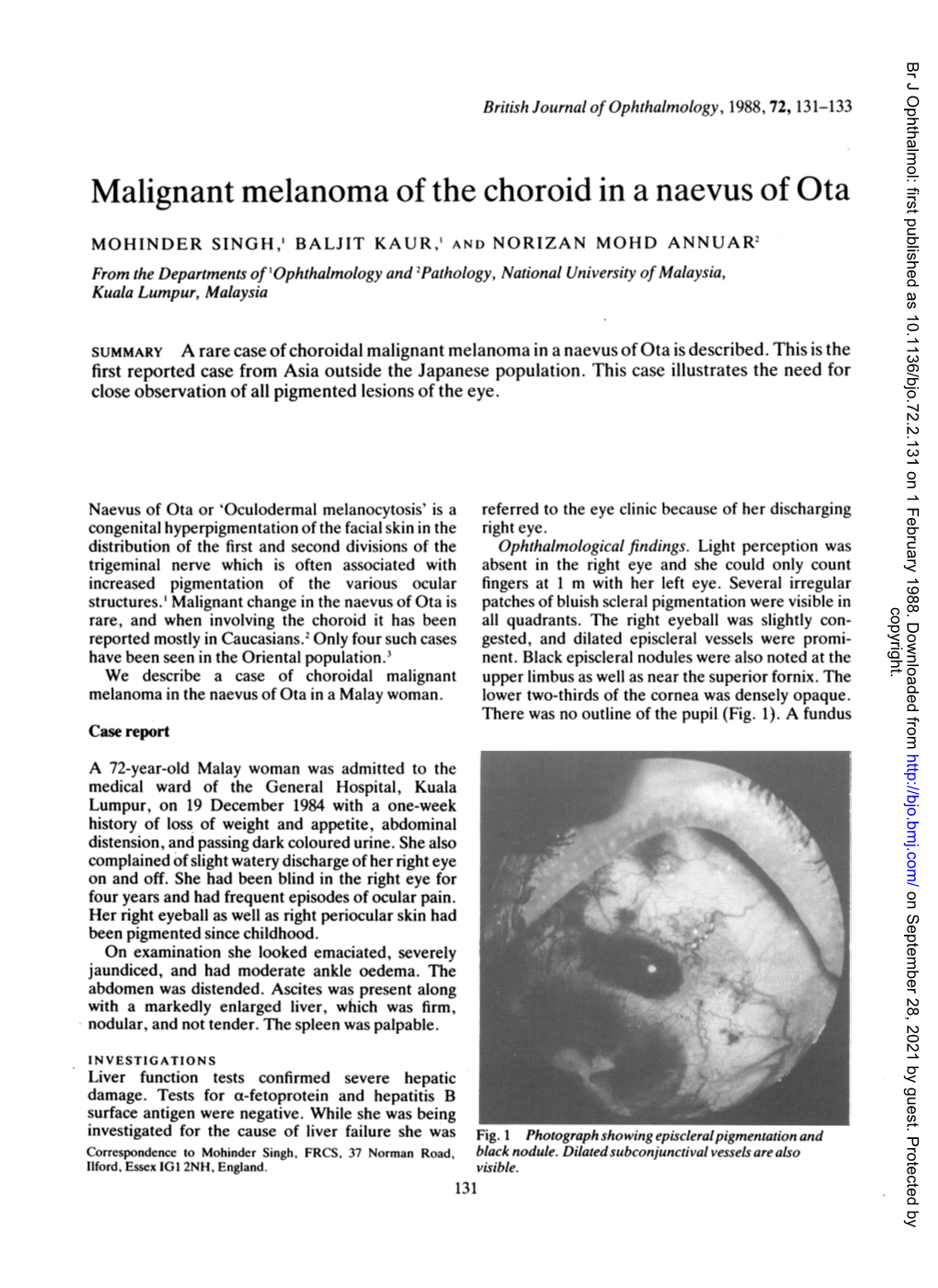 Malignant Melanoma of the Choroid in a Naevus of Ota