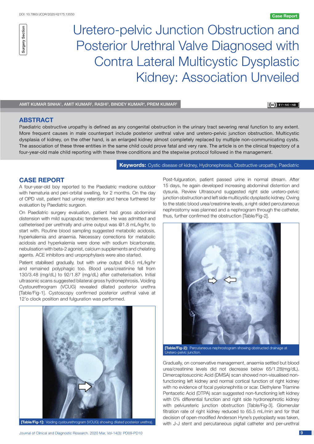 Uretero-Pelvic Junction Obstruction and Posterior Urethral Valve Diagnosed with Surgery Section Contra Lateral Multicystic Dysplastic Kidney: Association Unveiled