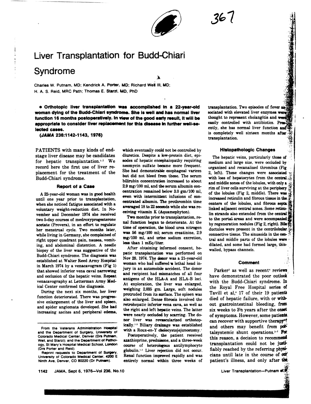 Liver Transplantation for Budd-Chiari Syndrome