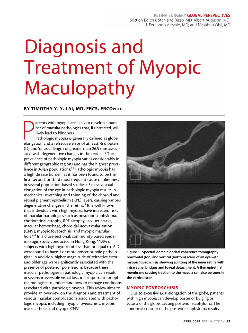 Diagnosis and Treatment of Myopic Maculopathy
