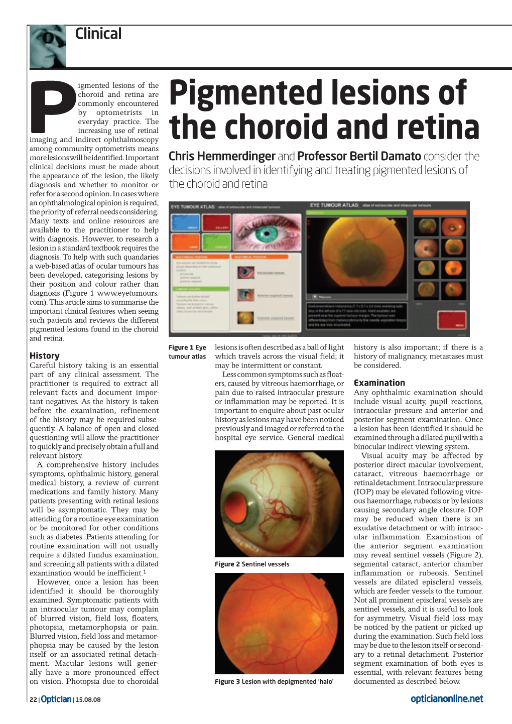 Pigmented Lesions of the Choroid and Retina