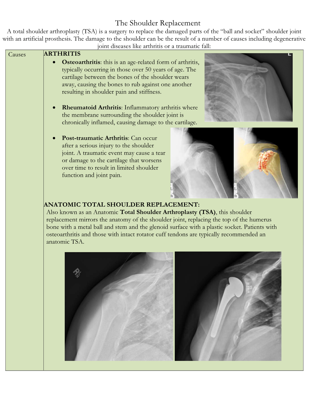 A Total Shoulder Arthroplasty (TSA) Is a Surgery to Replace the Damaged Parts of the “Ball and Socket” Shoulder Joint with an Artificial Prosthesis