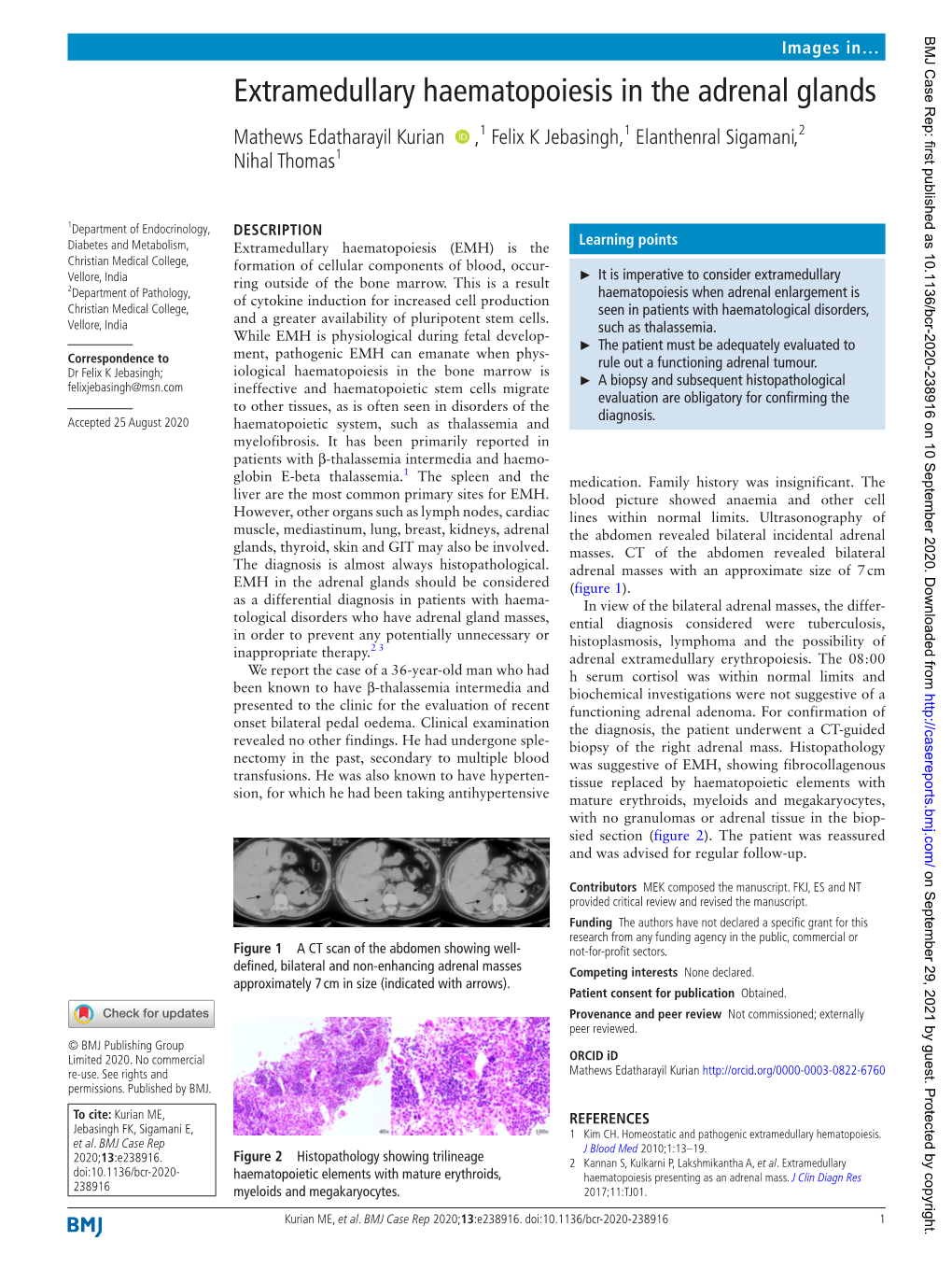 Extramedullary Haematopoiesis in the Adrenal Glands Mathews Edatharayil Kurian ‍ ‍ ,1 Felix K Jebasingh,1 Elanthenral Sigamani,2 Nihal Thomas1