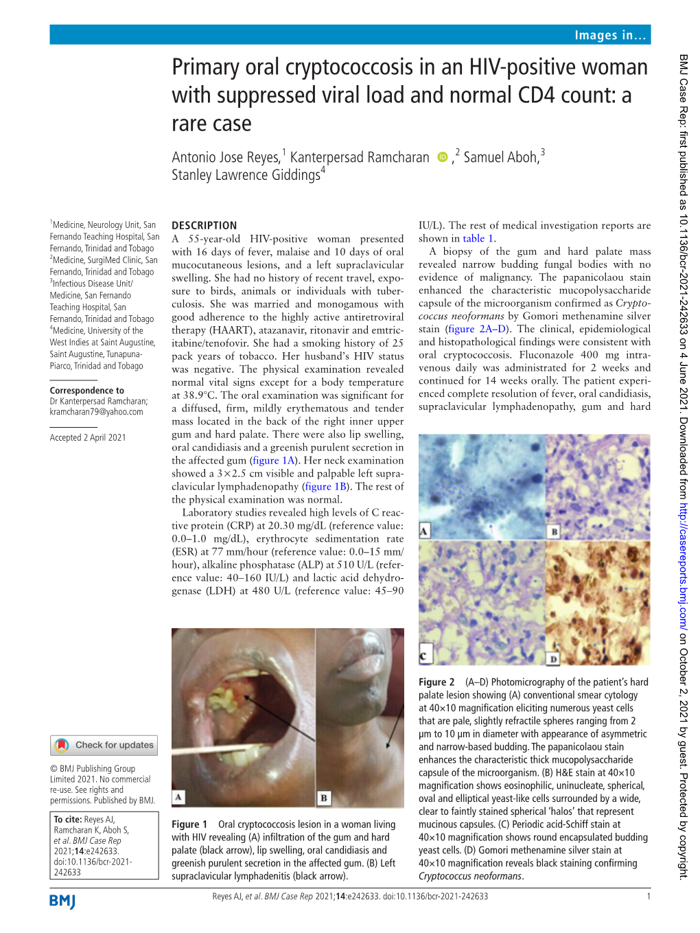 Primary Oral Cryptococcosis in an HIV-Positive Woman with Suppressed Viral Load and Normal CD4 Count