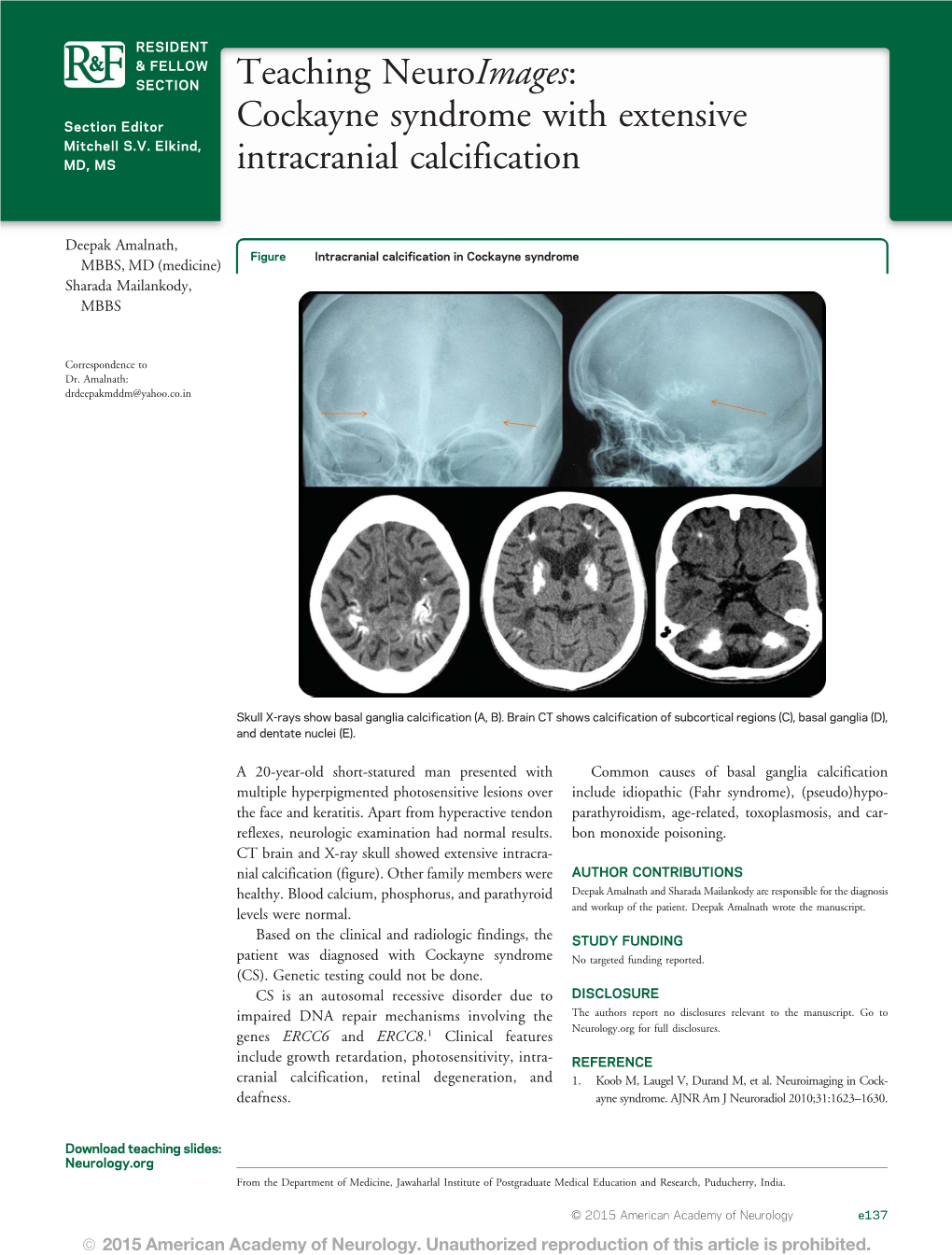 Cockayne Syndrome with Extensive Intracranial Calcification Deepak Amalnath and Sharada Mailankody Neurology 2015;84;E137 DOI 10.1212/WNL.0000000000001541