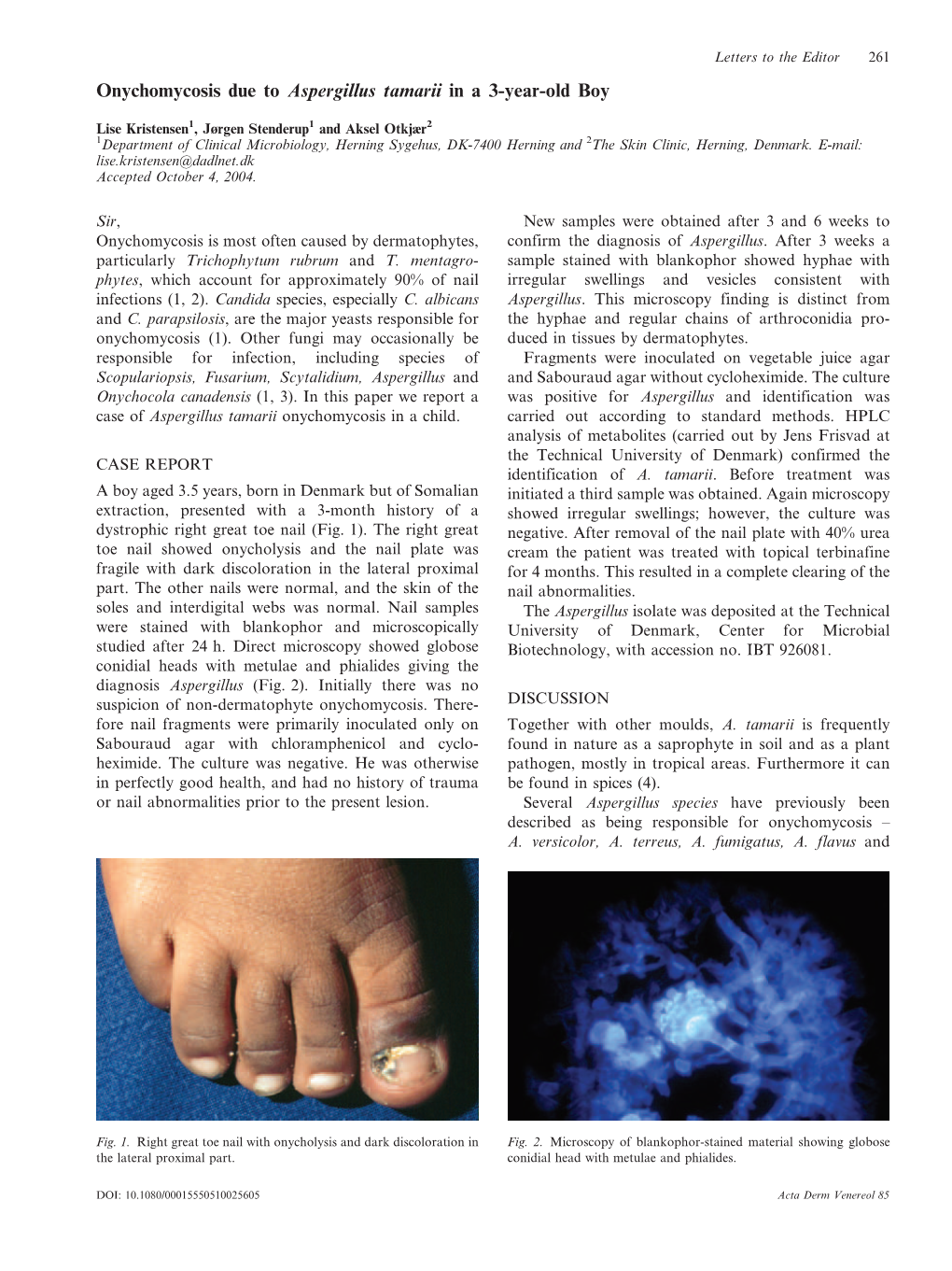 Onychomycosis Due to Aspergillus Tamarii in a 3-Year-Old Boy