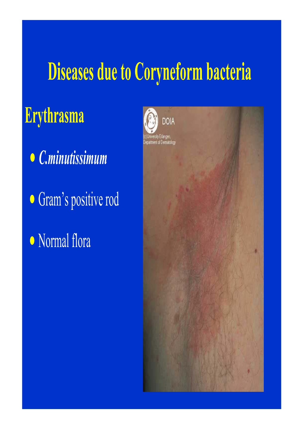 Diseases Due to Coryneform Bacteria Erythrasma  C.Minutissimum  Gram’S Positive Rod  Normal Flora Erythrasma Sites