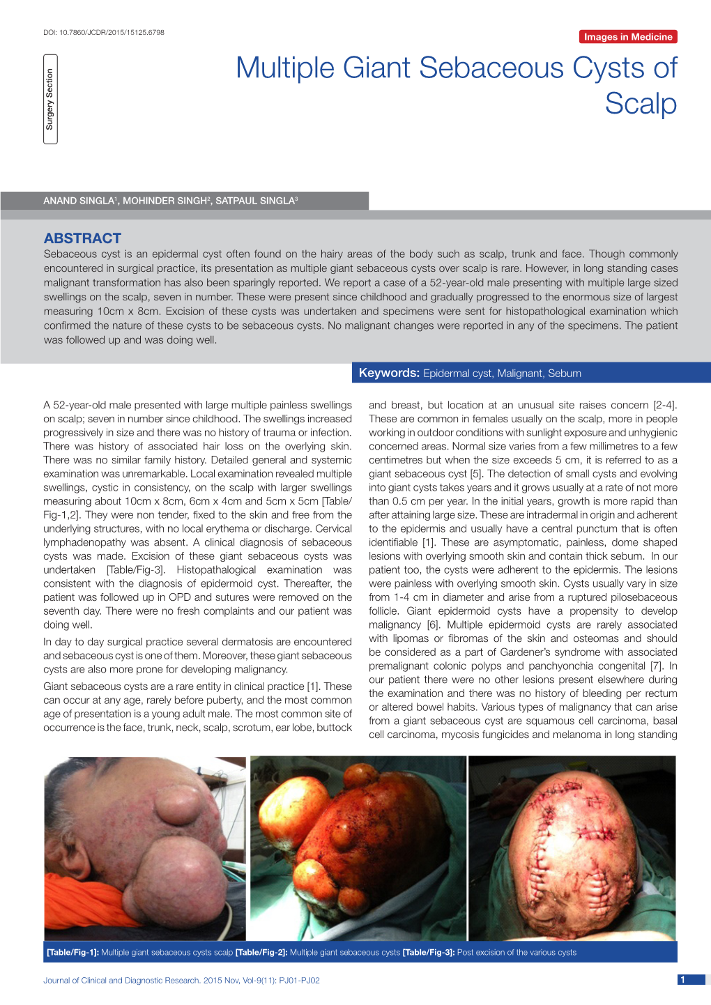 Multiple Giant Sebaceous Cysts of Scalp Surgery Section