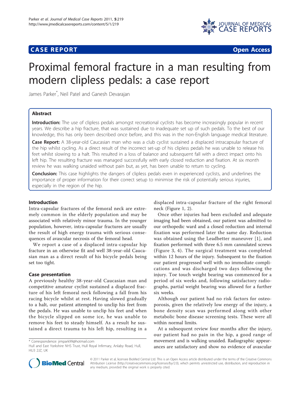 Proximal Femoral Fracture in a Man Resulting from Modern Clipless Pedals: a Case Report James Parker*, Neil Patel and Ganesh Devarajan