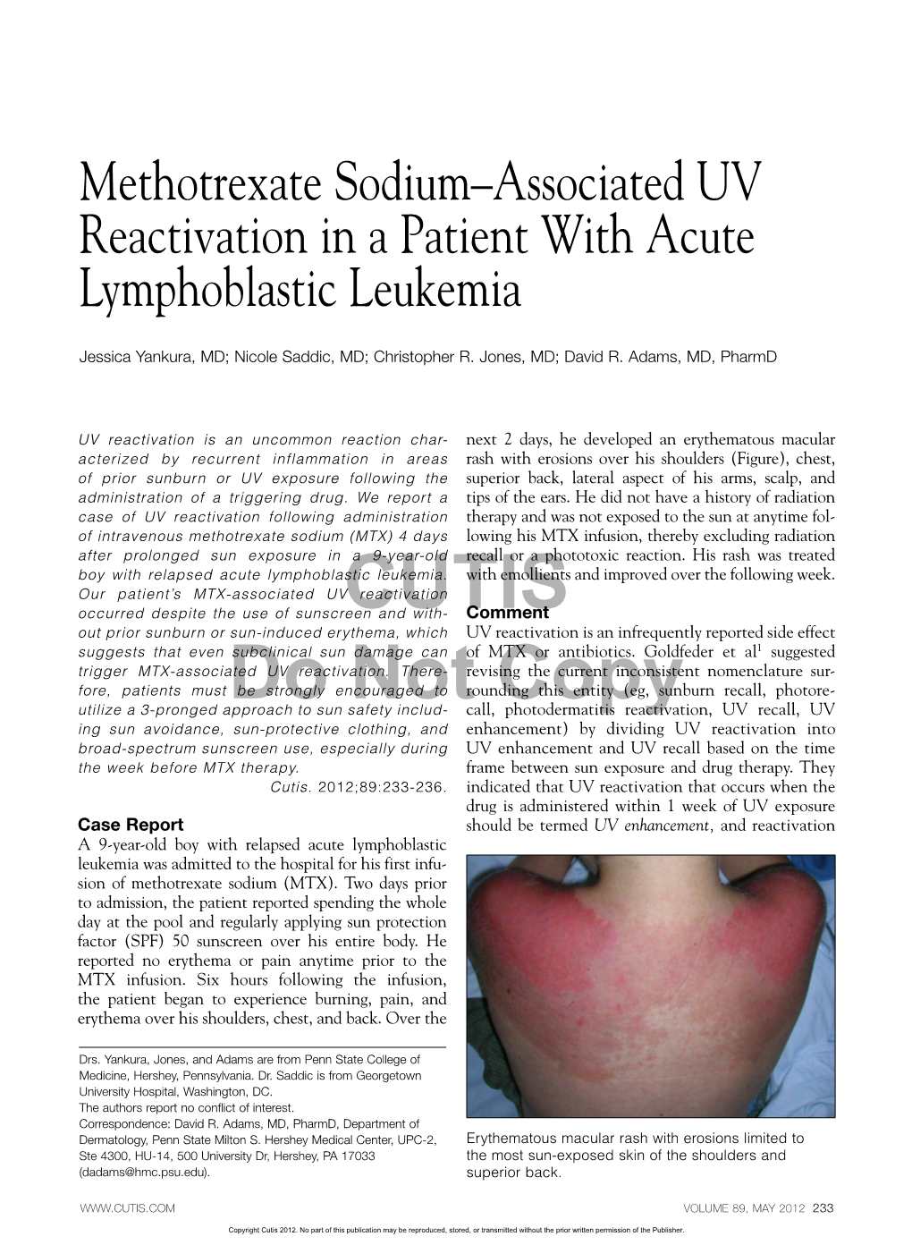 Methotrexate Sodium–Associated UV Reactivation in a Patient with Acute Lymphoblastic Leukemia