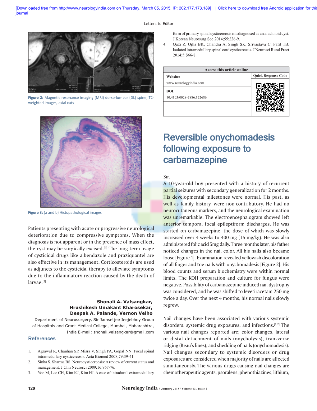 Reversible Onychomadesis Following Exposure to Carbamazepine