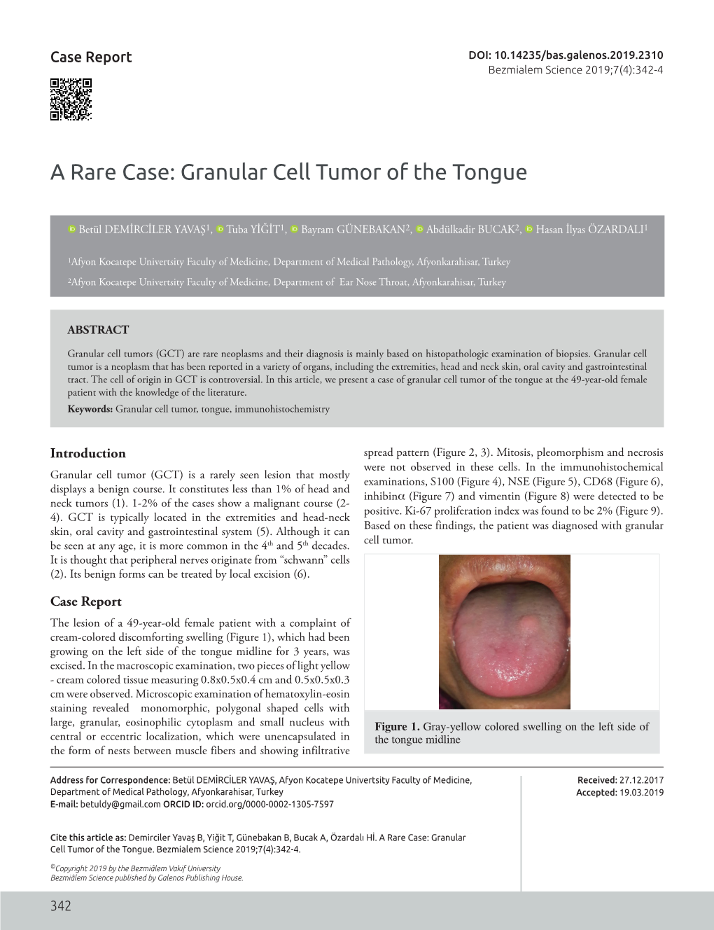 A Rare Case: Granular Cell Tumor of the Tongue
