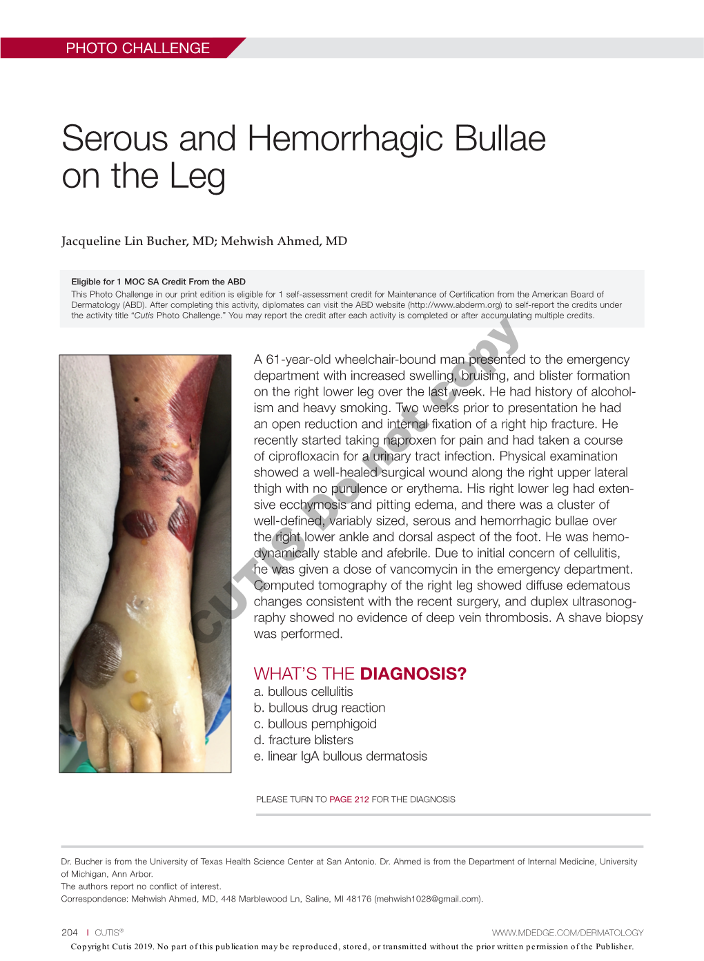 Serous and Hemorrhagic Bullae on the Leg
