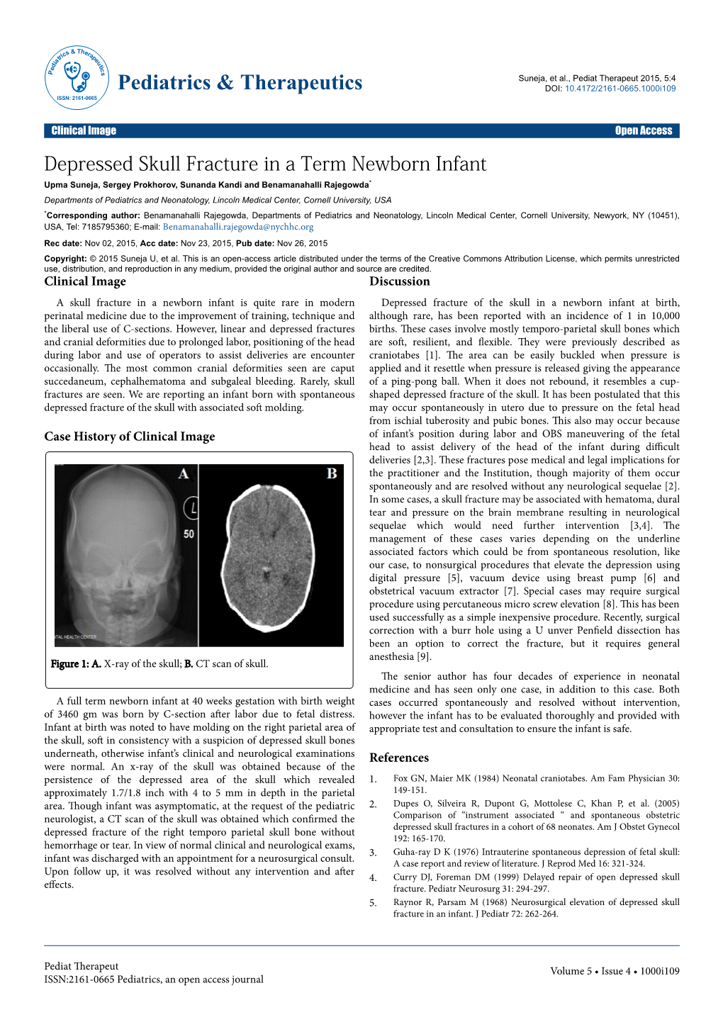 Depressed Skull Fracture in a Term Newborn Infant