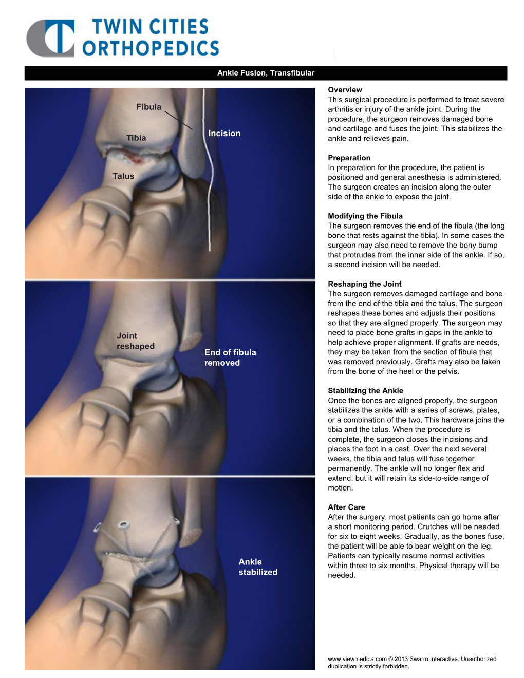 Ankle Fusion, Transfibular